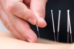 top 10 benefits of acupuncture