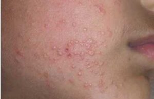 molluscum contagiosum