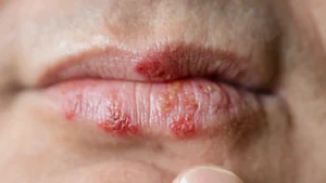 blister on lip not cold sore